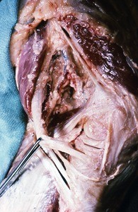 Natural color photograph of dissection of the left knee, medial view, with the forceps holding the sartorius muscle