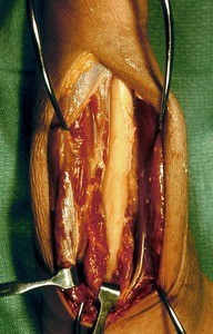 Natural color photograph of dissection of the wrist, showing the ulna