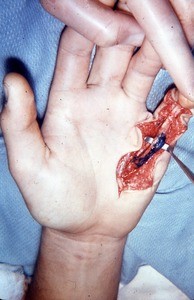 Natural color photograph of dissection of the fifth digit, anterior view, emphasizing the flexor digitorum superficialis tendon