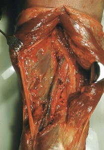 Natural color photograph of dissection of the popliteal fossa, showing the popliteal artery, the popliteal vein and the tibial nerve