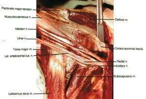 Natural color photograph of dissection of the right axilla, anterior view, emphasizing the brachial plexus and its major branches, with related structures