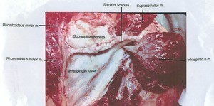 Natural color photograph of dissection of the back, scapular region, showing muscles related to the scapula; the infraspinatus muscle and supraspinatus muscle have been cut and reflected