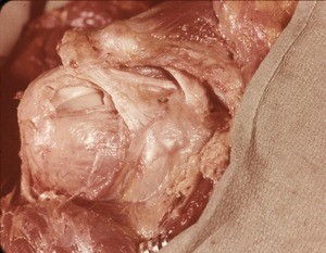 Natural color photograph of dissection of the right shoulder, anterior view, with the skin and deltoid muscle removed to show the glenohumeral joint capsule and