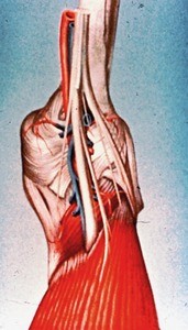 Posterior aspect of right knee, dissected to show deeper soft structures (popliteal artery and vein, sciatic nerve & its bifurcation to form tibial n. & common fibular n., medial & lateral retinacula, and popliteus muscle and soleus muscle)