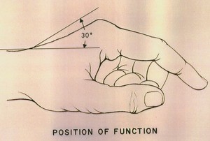 Illustration showing potential angle of extension at the wrist