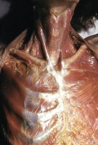 Natural color photograph of dissection of the thorax, anterior view, with the right pectoralis muscles removed to expose the ribs and intercostal muscles