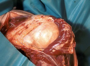 Natural color photograph of dissection of the left shoulder, anterior view, with the deltoid muscle reflected to expose the glenohumeral joint capsule