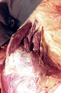 Natural color photograph of dissection of the right shoulder, posteroinferior view, showing the muscle structure of the shoulder region