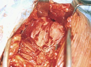 Natural color photograph of dissection of the left shoulder, superior view, with the muscles retracted to expose the glenohumeral joint capsule