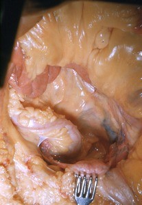 Natural color photograph of dissection of the pelvic cavity, anterolateral view, showing the pelvic viscera and mesentery with the right ovary retracted