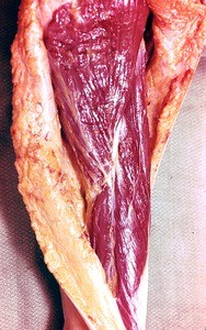 Natural color photograph of dissection of the right arm, anterolateral view