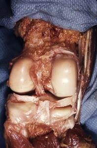 Natural color photograph of dissection of the right knee, posterior view, showing the tibial table and the lateral and medial femoral condyles