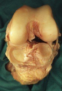 Natural color photograph of dissection of the knee, anterior view, with soft tissue removed and the joint flexed to reveal the articular surfaces of both the femur and tibia