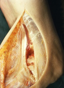 Natural color photograph of dissection of the right knee, lateral view, showing initial incision