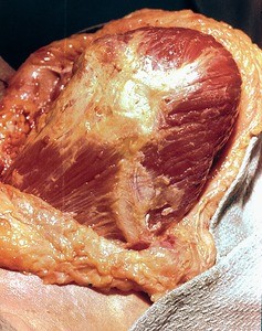 Natural color photograph of dissection of the shoulder, superior view, with the skin reflected to expose the superficial muscle structure