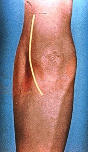 Illustration of surface anatomy of right elbow, posterior aspect, with outline of surgical incision for exposure of ulnar nerve