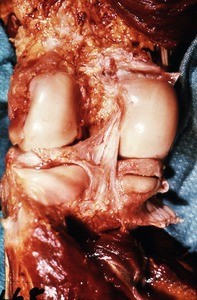 Natural color photograph of dissection of the knee, posterior view, showing the tibial table and the medial and lateral femoral condyles