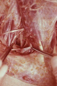 Natural color photograph of dissection of the right neck, anterior view, showing the sternocleidomastoid muscle, inferior belly of the omohyoid muscle, and an opened carotid sheath