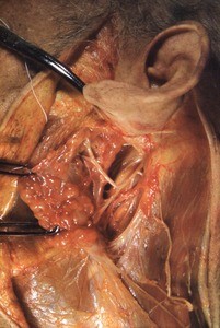 Natural color photograph of dissection of the left side of the face, lateral view, with the parotid gland reflected to expose branches of the facial nerve (cranial nerve VII)