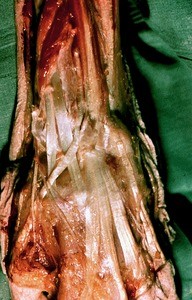 Natural color photograph of dissection of the left wrist, posterior view, with the extensor retinaculum cut and removed to reveal the tendons of the extensor muscles of the forearm