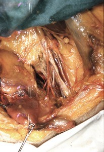 Natural color photograph of dissection of the peritoneal cavity, anterior view, showing abdominal viscera and associated mesentery, emphasizing neurovascular structures