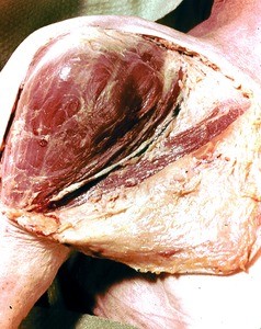 Natural color photograph of dissection of the left shoulder, posterior view, with the skin removed to expose the deltoid muscle