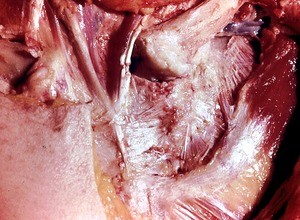 Natural color photograph of dissection of the thoracic wall, emphasizing the left sternoclavicular joint