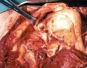 Natural color photograph of dissection of the left shoulder, anterior view, showing the glenohumeral joint capsule