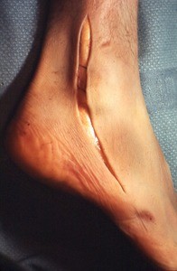 Natural color photograph of the right ankle, lateral view, showing initial incision