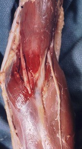 Natural color photograph of dissection of the left cubital fossa, anterior view