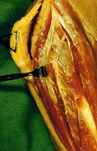 Natural color photograph of dissection of the forearm