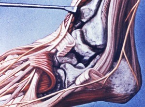 Illustration of left ankle and foot, dorsolateral aspect, dissected to show the tarsal bones(talus, navicular, cuboid & calcaneus), fibular retinaculum cut, and ext. digitorum brevis m. reflected