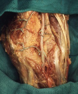 Natural color photograph of dissection of the popliteal fossa, showing the popliteal artery