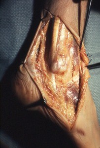 Natural color photograph of dissection of the right ankle, lateral view