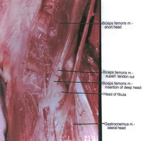 Natural color photograph of left knee, lateral view, showing muscles, tendons and bone with bicep femoris superficial tendon cut