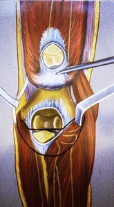 Illustration of posterior view of right elbow, showing humeral trochlea,after olecranon process has been cut and reflected upward along with triceps muscle's tendinous insertion. Radius and ulna are ghosted in