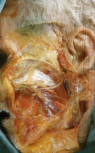 Natural color photograph of superficial dissection of the face, left lateral view