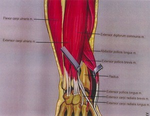 Illustration of dissection of the right arm, posterior view, showing the extensor musculature