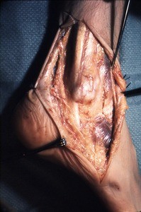 Natural color photograph of dissection of the right ankle, lateral view