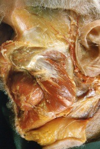 Natural color photograph of dissection of the face, lateral view, just anterior to the left ear