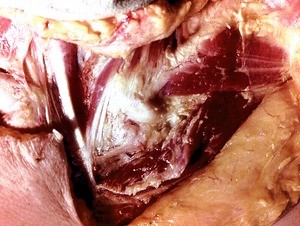 Natural color photograph of dissection of the thoracic wall, anterior view, showing the left clavicle and left pectoralis major m., which has been partially cut and reflected