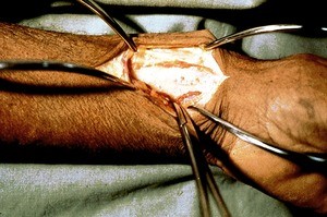 Natural color photograph of dissection of the left wrist, anterior view, with the skin incised and retracted