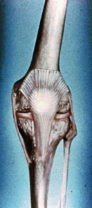 Illustration of articulated bones of left knee (femur, tibia, fibula, patella) and ligaments (patellar retinacula, medial & lateral collateral ligaments and infrapatellar ligament) & medial & lateral anterior view