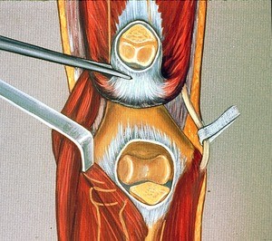 Illustration of left elbow, posterior view, humerus and ulna osteotomized and olecranon process turned up; ulnar nerve grasped in forceps; outlines of shafts of humerus, radius & ulna ghosted in with yellow lines;dense black line between reflected, cut olecranon and proximal humerus