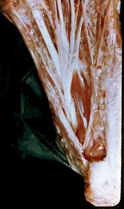 Natural color photograph of dissection of the plantar surface of the left foot