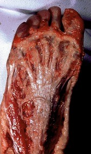 Natural color photograph of dissection of the plantar surface of the right foot