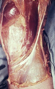 Natural color photograph of dissection of the right knee, medial view