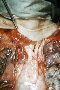 Natural color photograph of dissection of the thorax, anterior view, with the rib cage removed to reveal the lungs, mediastinum, nerves, and great vessels