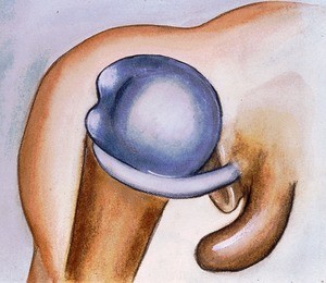 Illustration/drawing of dissected right glenohumeral joint, in lateral dislocation (note tendon of long head of biceps in relation to synovial capsule and head of humerus)