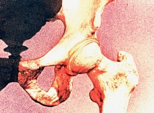 Illustration of anterior view of total skeleton of left hip joint, including acetabular ligament